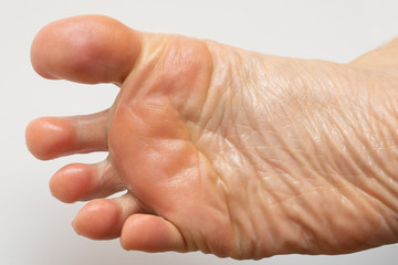 Treatment with natural oils for feet with dry skin, close-up of a female foot with freshly smeared moisturizing oil