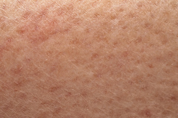 Skin closure that needs care following long exposure to uva uvb rays and revitalization or local spots and weak pores and moles