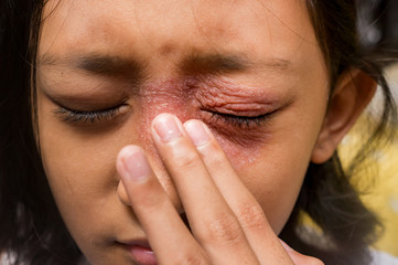 Southeast Asian ethnicity teenage girl annoyed with itchy skin disease, dermatitis problem on her...