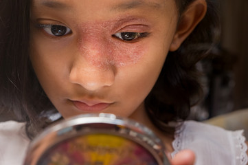 Southeast Asian ethnicity teenage girl with circular shape skin rash on her face around the eye and...