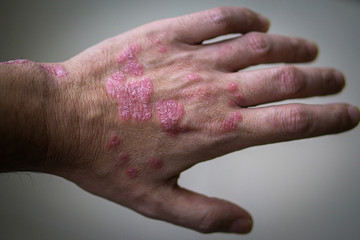 Psoriasis. autoimmune skin disease. man's hand with pockets of psoriasis lesion on a gray background