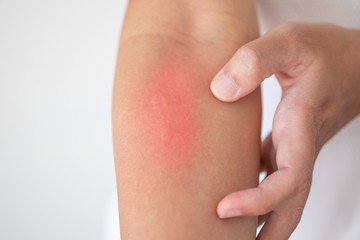 man itching and scratching on arm from itchy dry skin eczema dermatitis