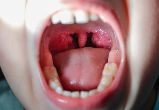 Colds open mouth with red, inflamed glands