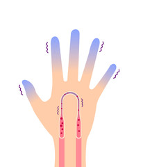 Cold hand blood circulation illustration (sensitivity to cold, cold fingertips)