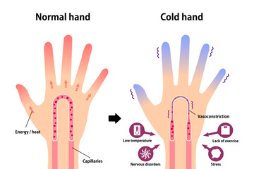 Comparison illustration of normal hand and cold hand ( sensitivity to cold, cold fingertips)