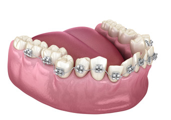 Abnormal teeth position and Clear braces tretament. Medically accurate dental 3D illustration