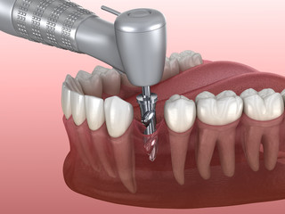 Drilling of bone while dental implant placement. Medically accurate 3D illustration of human teeth and dentures concept