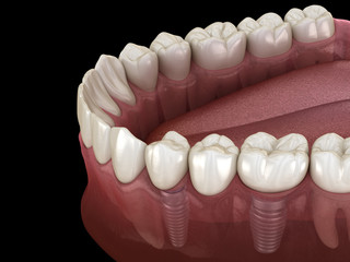 Dental bridge supported by implants. Medically accurate 3D illustration of human teeth and dentures concept