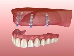Maxillary prosthesis with gum All on 4 system supported by implants. Medically accurate 3D illustration of human teeth and dentures