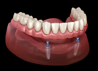 Mandibular removable prosthesis All on 2 system supported by implants with ball attachments. Medically accurate dental 3D illustration
