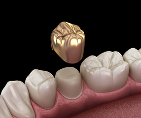 Golden crown premolar tooth assembly process. Medically accurate 3D illustration of human teeth treatment