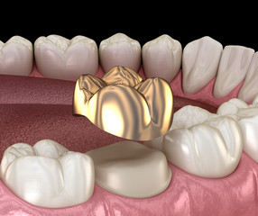 Golden crown molar tooth assembly process. Medically accurate 3D illustration of human teeth treatment
