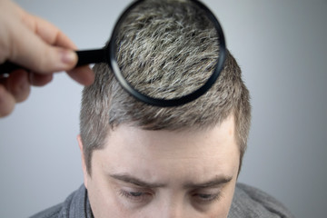 Fototapeta premium A trichologist examines a young man’s gray hair under a magnifying glass. Earlier bleaching of hair and pigment as a sign of low melanin in a guy’s body