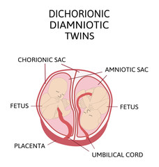 Anatomy of abdomen with twins. Twin types infographic elements in flat design. Monozygotic or Dizygotic Placentation of twins medical