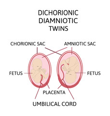 Anatomy of abdomen with twins. Twin types infographic elements in flat design. Monozygotic or Dizygotic Placentation of twins medical