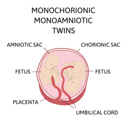 Anatomy of abdomen with twins. Twin types infographic elements in flat design. Monozygotic or Dizygotic Placentation of twins medical