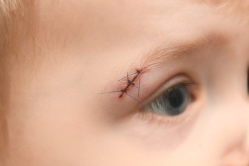 Wound on the eyebrow of a kid after a bruise