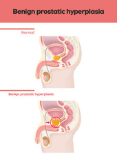 Obraz premium 메디컬일러스트 질환