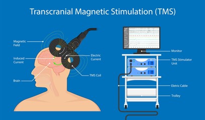 Transcranial magnetic stimulation TMS non invasive field obsessive compulsive disorder PTSD treat - obrazy, fototapety, plakaty