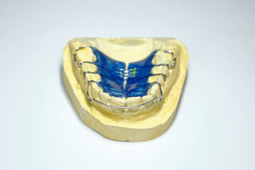 Dental prosthesis