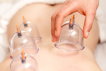 Vacuum medical cups on back.
