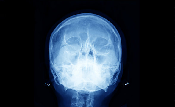 X-Ray of human skull bone 