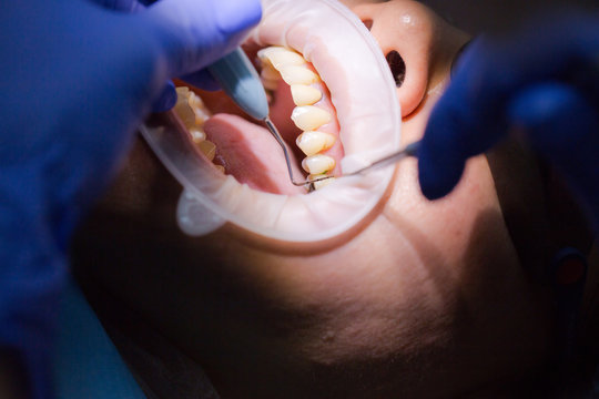 Asian Female Patient On Dentist Appointment During Dental Procedure. Human Mouth Open Close Up. Spot Light In A Face. The Doctor Examines The Gums With A Periodontal Measuring Probe. Real Process.