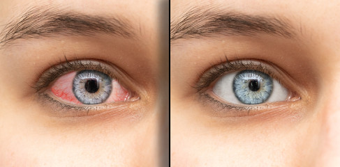 Before and after closeup view of caucasian female red irritated and healthy eye. Healthcare and...