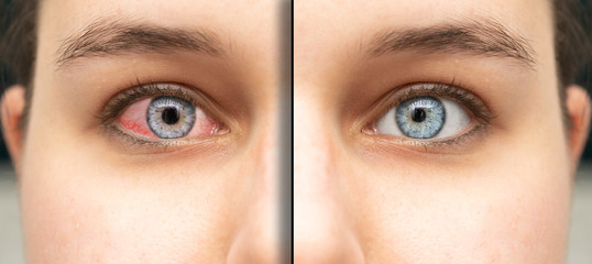 Image collage comparing before and after closeup view of caucasian female red and healthy eye. Eye irritated by infection of eyeball. Healthcare and eyecare concept...