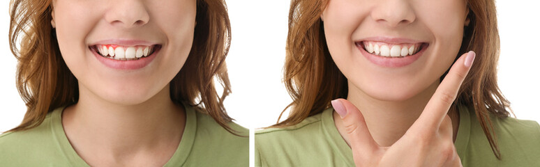 Young woman with and without gum inflammation on white background