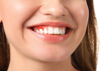 Woman with gum inflammation, closeup