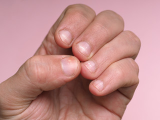 White spots on the nails of the male hand caused by a deficiency of calcium, zinc or poisoning by...