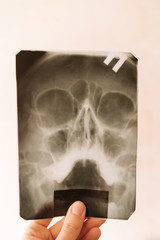 X-ray of the skull in the diagnosis of sinusitis on a white background