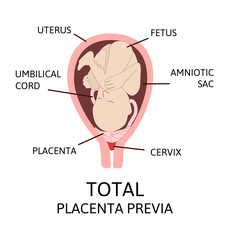Fototapeta premium Different Placental Locations During Pregnancy. Major and Normal placenta previa, total and partial.