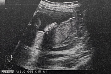 Ultrasound of baby in pregnant woman, Doctor reading test results of pregnant woman by ultrasound.