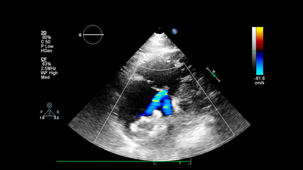 Image of the heart during transesophageal ultrasound with Doppler mode.