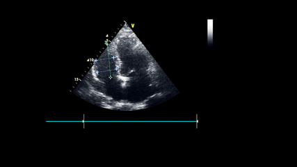 Image of the heart in gray-scale mode during transesophageal ultrasound.