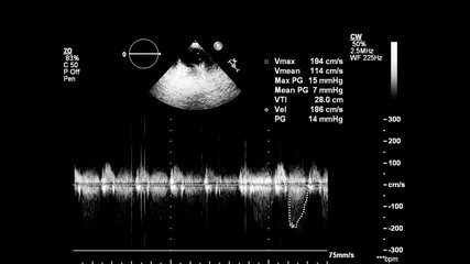 Image of the heart in gray-scale mode during transesophageal ultrasound.