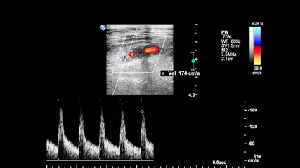 Pulse wave Doppler ultrasound examination of vessels.