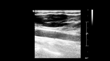 Ultrasound examination of blood vessels in grayscale mode.