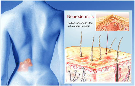 Haur-Neurodermitis.Schuppenflechte