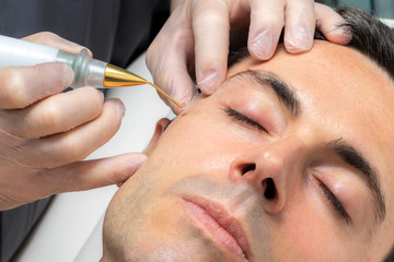 Close up detail of laser plasma pen removing facial melanoma on middle aged man.