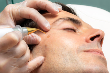 Macro close up of laser plasma pen removing facial melanoma on middle aged man.