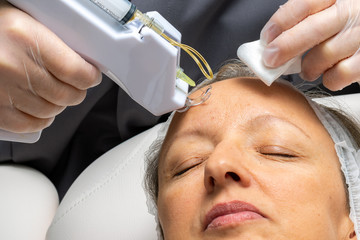 Middle aged woman having mesotherapy micro needling therapy on forehead.