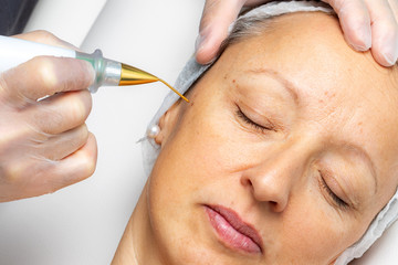 Top view of laser plasma pen removing facial wart on middle aged woman.