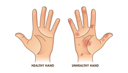 Fototapeta premium Healthy and unhealthy hand vector illustration