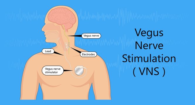 Vagus Nerve Stimulation VNS Device Depression Electrical Impulses Treat Epilepsy 