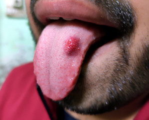 A closeup of a diseased tongue in which a red spot glosses. Burning and discomfort of the tongue