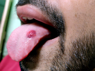A closeup of a diseased tongue in which a red spot glosses. Burning and discomfort of the tongue
