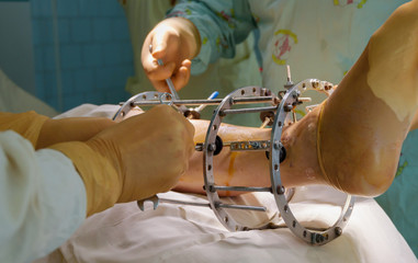 External ring fixation technique in orthopedic medicine